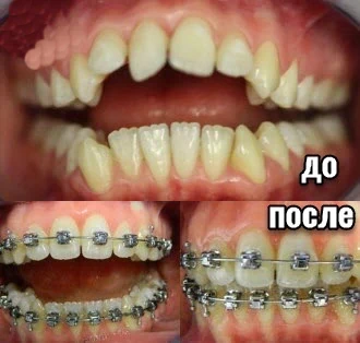 Ортодонтия исправление неправильного прикуса в Москве ВАО Гольяново
