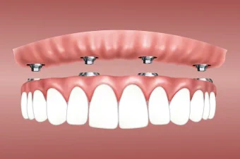 Имплантация и протезирование зубов по системе All-on-4 под ключ