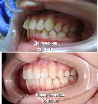 Исправление прикуса ортодонтом - вариант результата 1