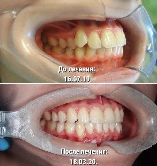 Исправление прикуса ортодонтом - вариант результата 3