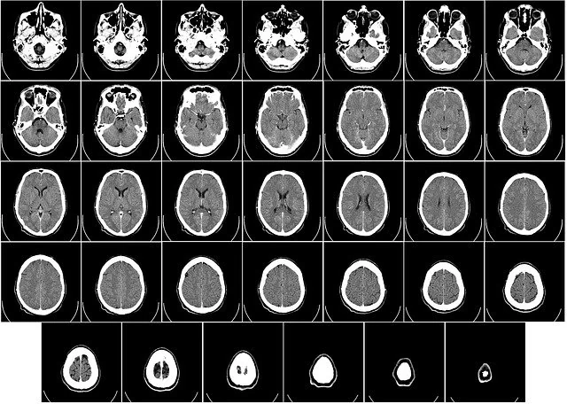 Результаты обследования мозга при помощи компьютерной томографии