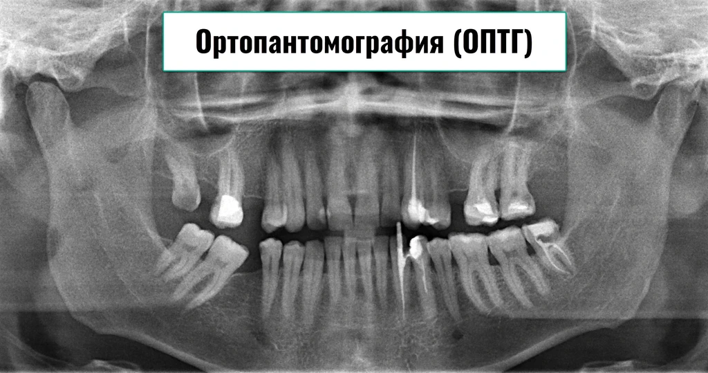 Вид панорамного рентгеновского снимка зубов (ОПТГ) в Москве на Щелковской
