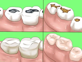 Установка пломбы на зуб - до и после