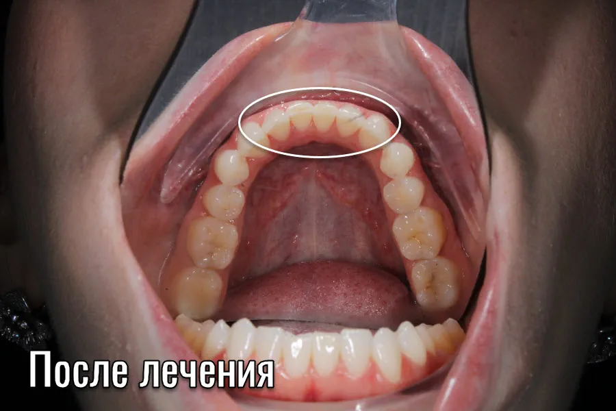 Вид после использования элайнеров для выравнивания прикуса зубов