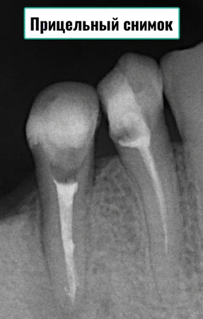Вид прицельного рентгеновского снимка зубов в Гольяново (ВАО)