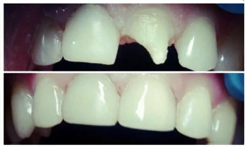 Реставрация зубов - до и после