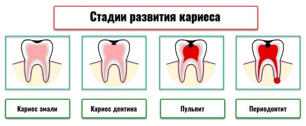 Виды разрушения и лечение зубов от кариеса, пульпита, периодонтита