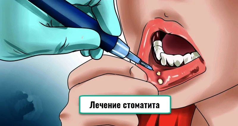 Лечение стоматита у зубного врача