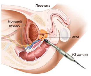 Процесс биопсии предстательной железы