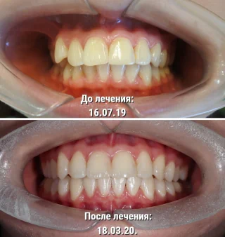 Исправление прикуса ортодонтом - вариант результата 2