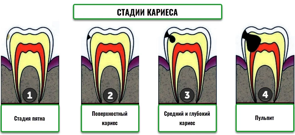 Этапы развития зубного кариеса